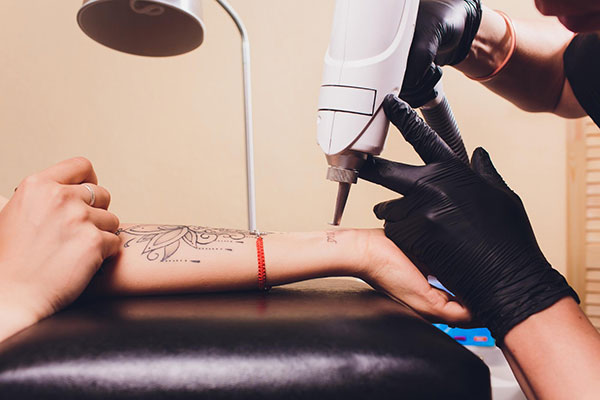 Borrar tatuajes en Rosario