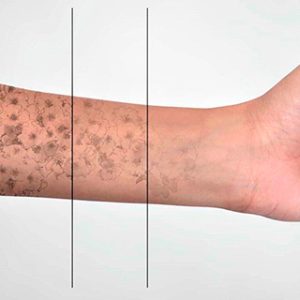 Alternative view of Borrar tatuaje de 2cm x 2cm