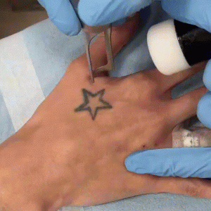 Así es una sesión para borrar un tatuaje en Rosario