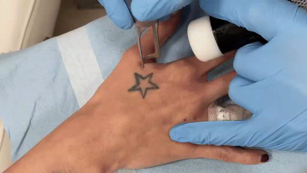 Así es una sesión para borrar un tatuaje en Rosario